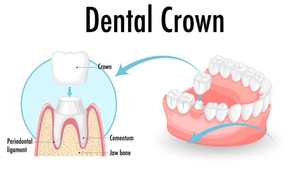 What is a Dental Crown