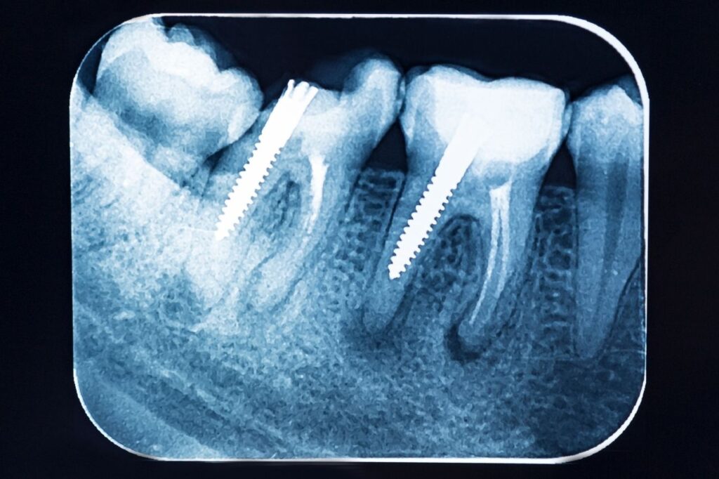 Dental X-Rays