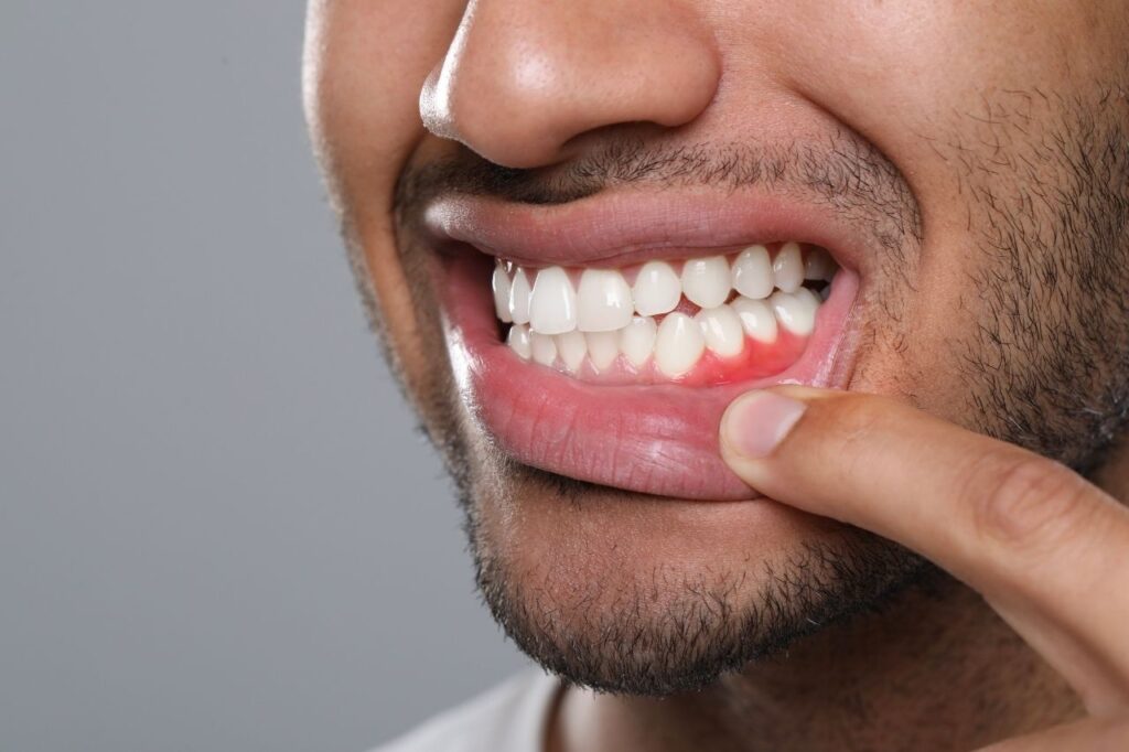 Gum Disease Treatment